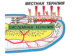 Комбинированная терапия, применяемая при лечении онихомикозов различной этиологии, микоз стоп (кистей), гиперкератозов подногтевых и подошвенных. Рисунок предоставлен www.gribok.ru