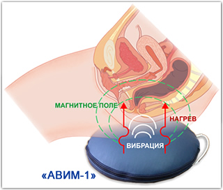 Применение аппарата "АВИМ-1" в гинекологии
