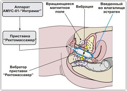 Второй этап лечения - вагинальный вибромагнитный массаж в присутствии крема "Овестин" с помощью приставки "РЕКТОМАССАЖЕР".